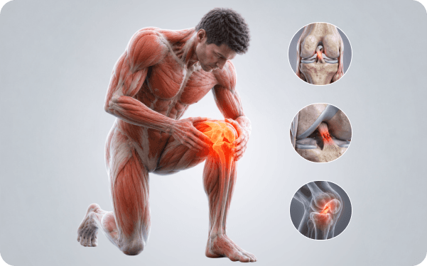 Athlete holding an injured knee with the ACL region highlighted