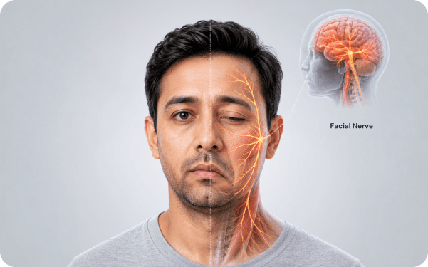 3D illustration of the facial nerve and facial muscles highlighting the inflamed nerve pathway