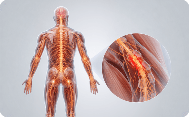 3D illustration of the peripheral nervous system highlighting affected nerve pathways