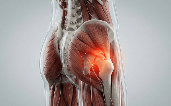3D anatomy illustration of the hip joint and surrounding muscles with highlighted pain area