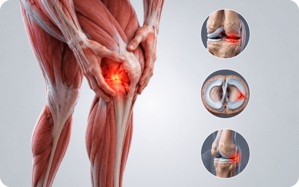 Anatomical illustration of the knee with the torn meniscus cartilage highlighted