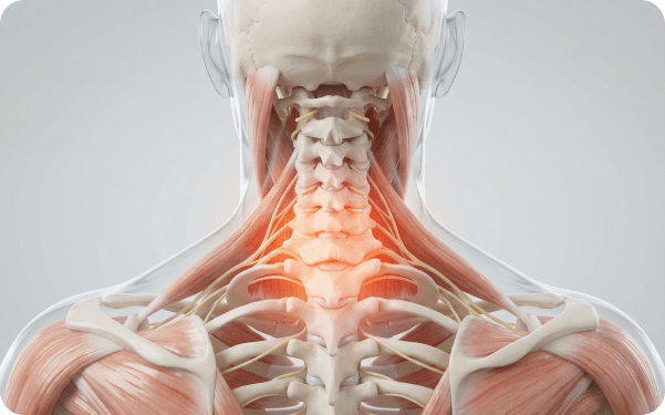 3D anatomy illustration of the neck muscles and spine with highlighted pain area