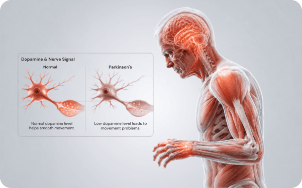 3D illustration comparing normal and Parkinson's dopamine nerve signals with an affected human figure