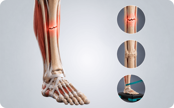 Anatomical illustration of a healing bone fracture in the lower leg with the surrounding joints highlighted