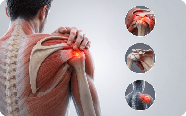 Anatomical illustration of the shoulder with the injured rotator cuff tendons highlighted