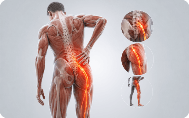 3D anatomy illustration of the spine and sciatic nerve with highlighted pain area travelling down the leg