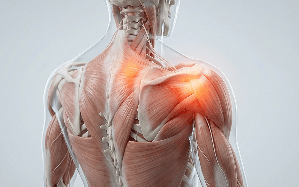 3D anatomy illustration of the shoulder muscles with highlighted pain area