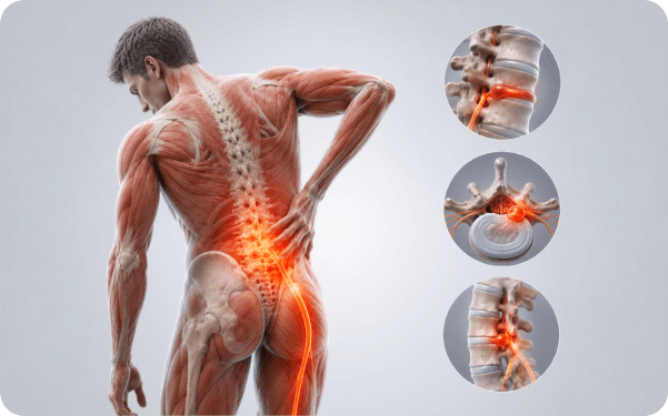 3D anatomy illustration of the spine with a highlighted herniated disc pressing on a nerve root