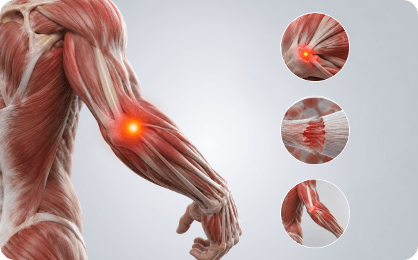 Anatomical illustration of the forearm with the irritated tendons on the outer elbow highlighted