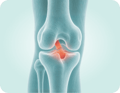 ACL Injury