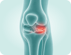 Meniscus Tear