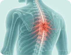 Spinal Cord Injury