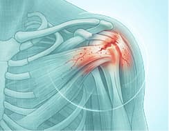Sports Injury